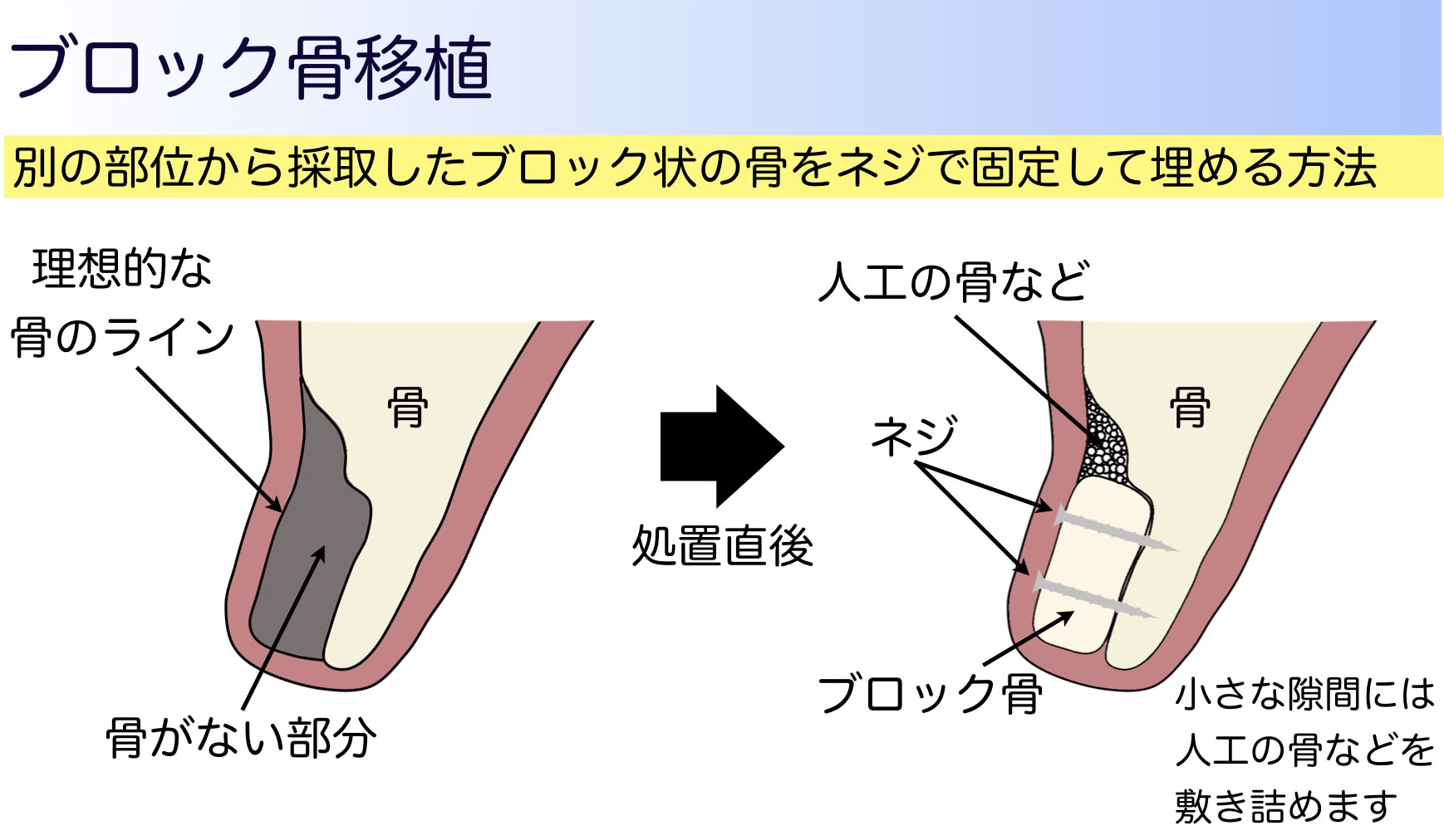 ブロック骨補填
