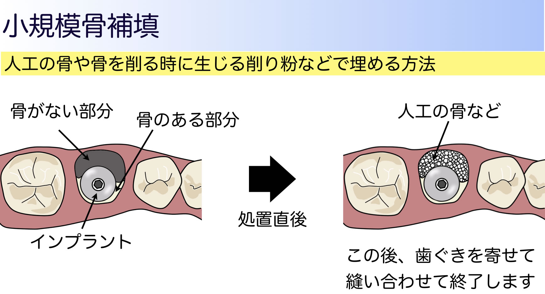小規模骨補填