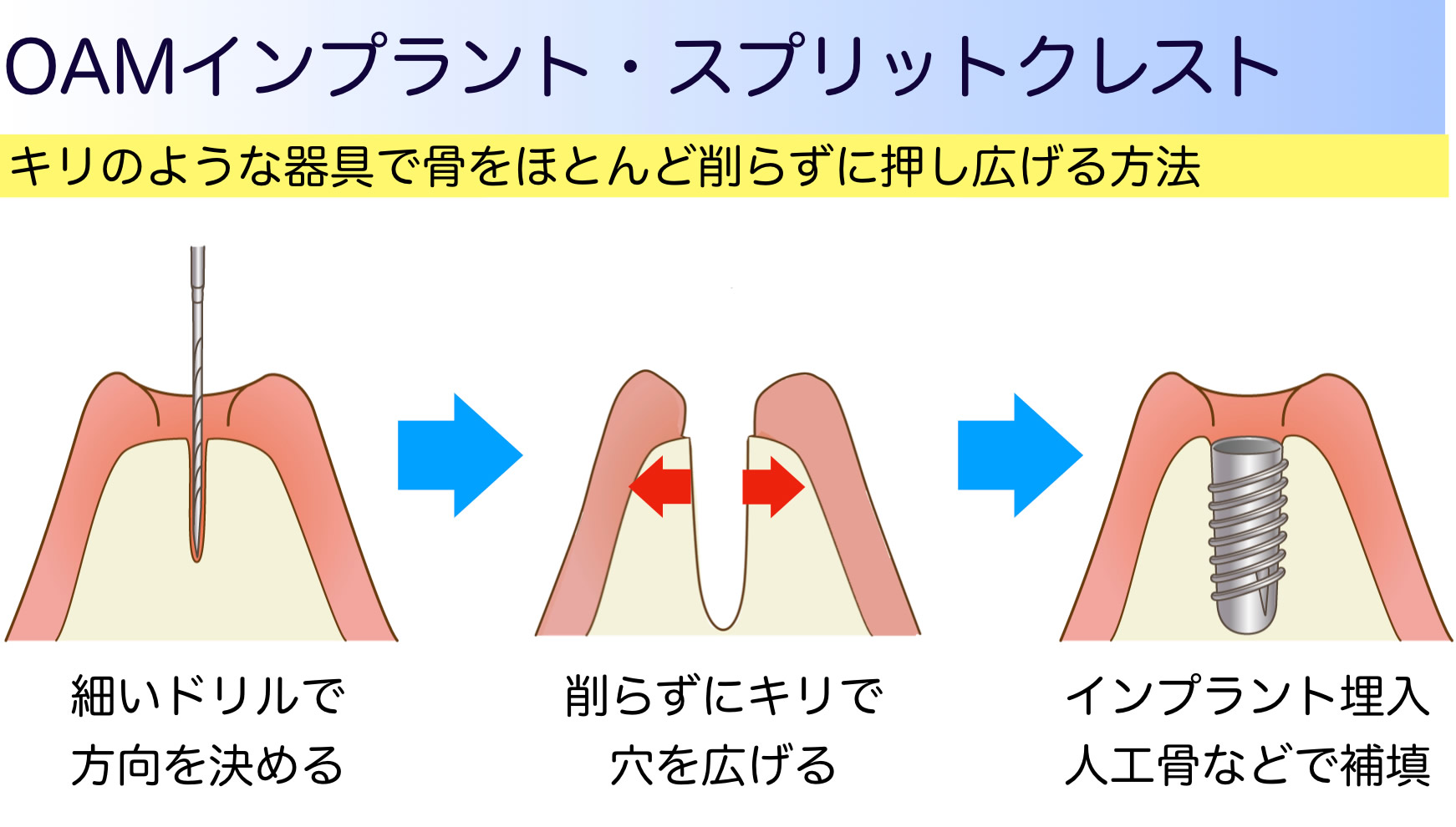 ＯＡＭインプラント