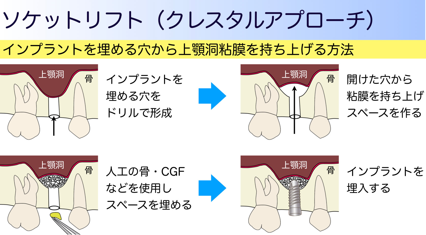ソケットリフト