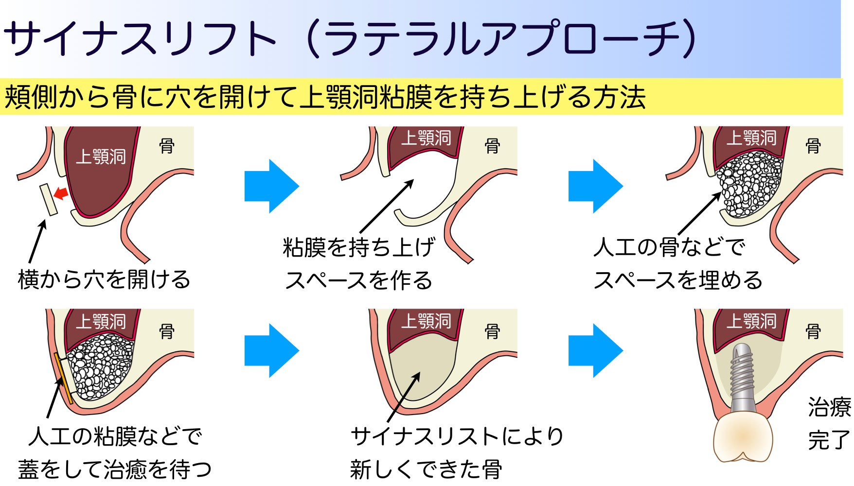 サイナスリフト