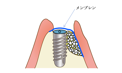 メンブレン