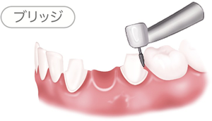 インプラント