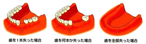 インプラント治療