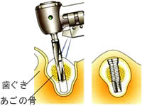インプラント治療