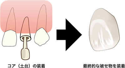 5,被せもの作製
