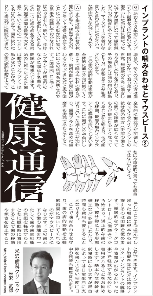 インプラントの噛み合わせとマウスピース②
