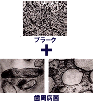 プラーク＋歯周病菌