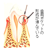 第２期（軽度の歯周炎）