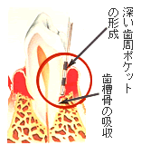 第３期（中程度の歯周炎と歯槽骨の吸収）