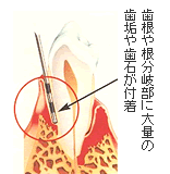 第４期（重度の歯周炎と歯槽骨の吸収）